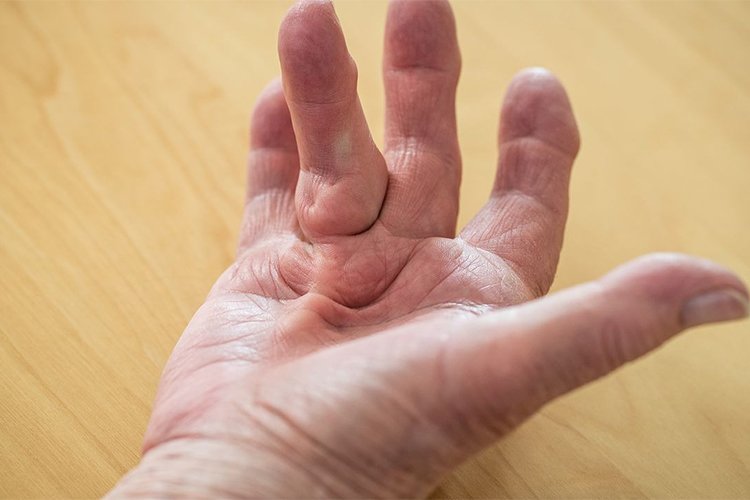 Dupuytren's Contracture of the Hand